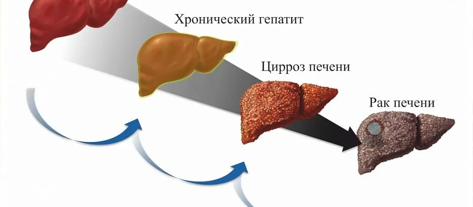 Гепатит
